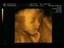 Baby Chloe 27 week 4D scan