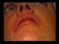 Lip injections: Discovery Health interviews Dr. Treacy Lip injections: Discovery Health interviews Dr. Treacy
