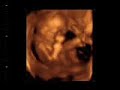 Bebe de 18 semanas