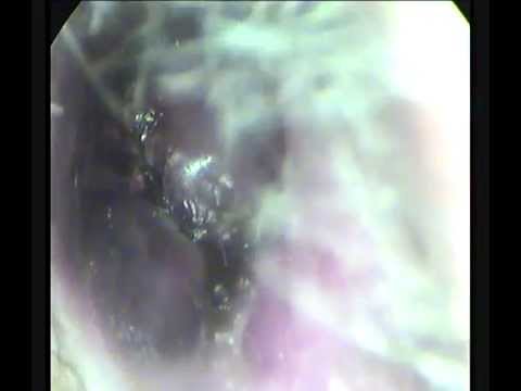 meatus