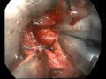 Click here to watch this video ENDOSCOPIC DISCECTOMY