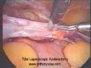 Total Laparoscopic Hysterectomy Total Laparoscopic Hysterectomy