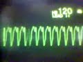 ECG Video: Ventricular Tachycardia