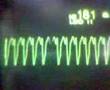 ECG Video: Ventricular Tachycardia