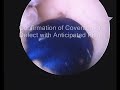Arthroscopic Articular Cartilage Replacement