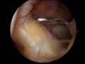 Knee arthroscopy (part IV)