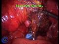 NATURAL ORIFICE SURGERY. COLON CANCER. LAPAROSCOPIC SURGERY. HOSPITAL BORMUJOS.