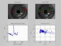 Iris tracking during LASIK