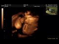 3D Ultrasound of 27 Weeks Baby Girl