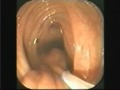 Endoscopia digestiva - Colonscopia - Polipectomia con tecnica del Filo da pesca