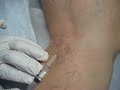 Sclerotherapy With Dr. Paul J Sos M.D. RVT Sclerotherapy With Dr. Paul J Sos M.D. RVT