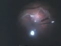 Vitrectomy for retinal detachment Radial Keratotomy