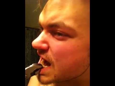 how to remove braces