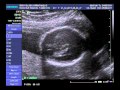 20 SEMANAS DE GESTA��O , DESCOBRI � A ELLOISY...