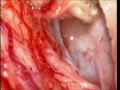 spinal cord tumors-microsurgical treatment-dr suresh dugani/HUBLI/KARNATAK/INDIA