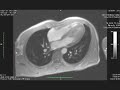 Cardiac MRI movie