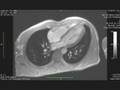Cardiac MRI movie