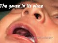 Feeding Obturatore for Asseer 4 month baby with Cleft Palate, Clinical Pediatric Dentistry