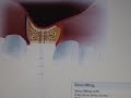 Sinus lift video :using MIS-Implants Bone compression kit