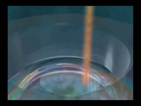 IntraLase SBK All Laser LASIK