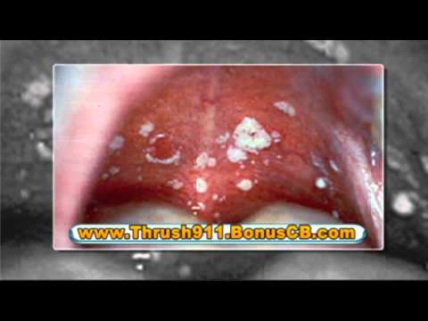 how to treat thrush if pregnant
