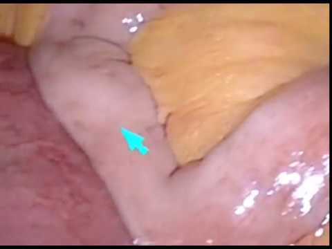 how to treat bowel obstruction