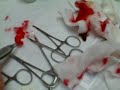 Lipoma Removal (Pt. 3)