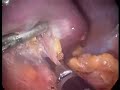 Laparoscopic Splenectomy Laparoscopic Splenectomy