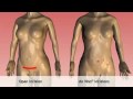 da Vinci robotic surgery for hysterectomy