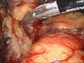 Laparoscopic Nephrectomy - Transvaginal Approach Laparoscopic Nephrectomy - Transvaginal Approach