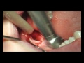 Bone regeneration
