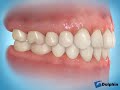 Tooth Implant (Posterior)