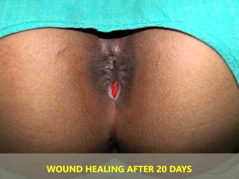 how to cure fissure at home