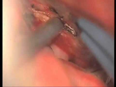 Lateral Supraorbital Access For TSM - Part 2