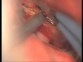 LSO for Tuberculum Sellae Meningioma Video 2