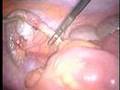 Appendictomy Surgery by Dr Faraj Al Shamie
