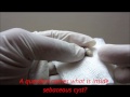 What Is Inside Sebaceous Cyst