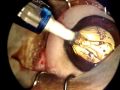 Phacoemulsification in a dog followed by an IOL implant Phacoemulsification in a dog followed by an IOL implant