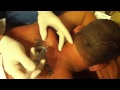 Cyst lancing