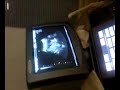 �chographie 3 mois