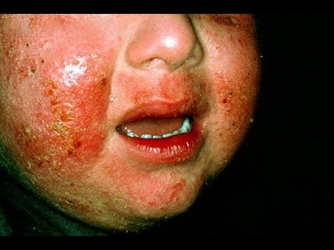 how to cure eczema on a baby