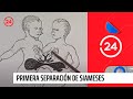 Primera separación de Siameses