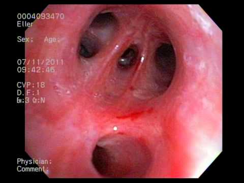 how to dissolve mucus in the lungs