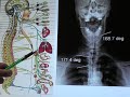 Subluxation a description of an epidemic silent killer Subluxation a description of an epidemic silent killer