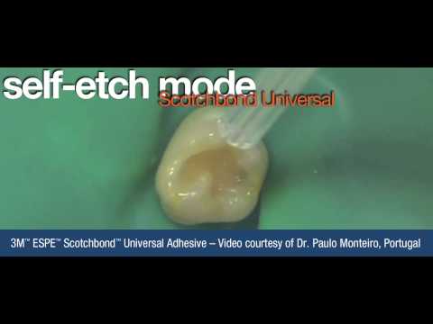 strong glue repair - http://www.henryschein.co.uk The versatility of 3M™ ESPE™ Scotchbond™ Universal Adhesive is shown in this clinical application video featuring total-tech, se...