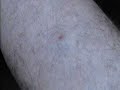 LesionsIV Shingles (Herpes Zoster)