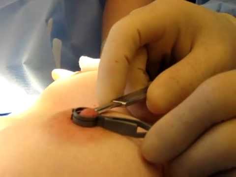 how to reduce nipple size