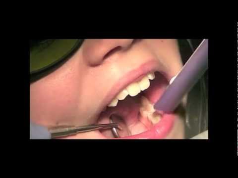 how to fix tooth decay