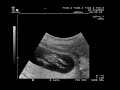 Eco, 12 semanas, Sofi Larre Borges Hanisch