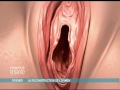 Hymenoplastie